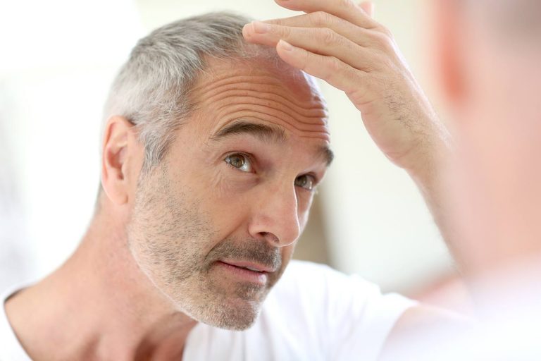 Men's hair loss - causes, treatment and solutions